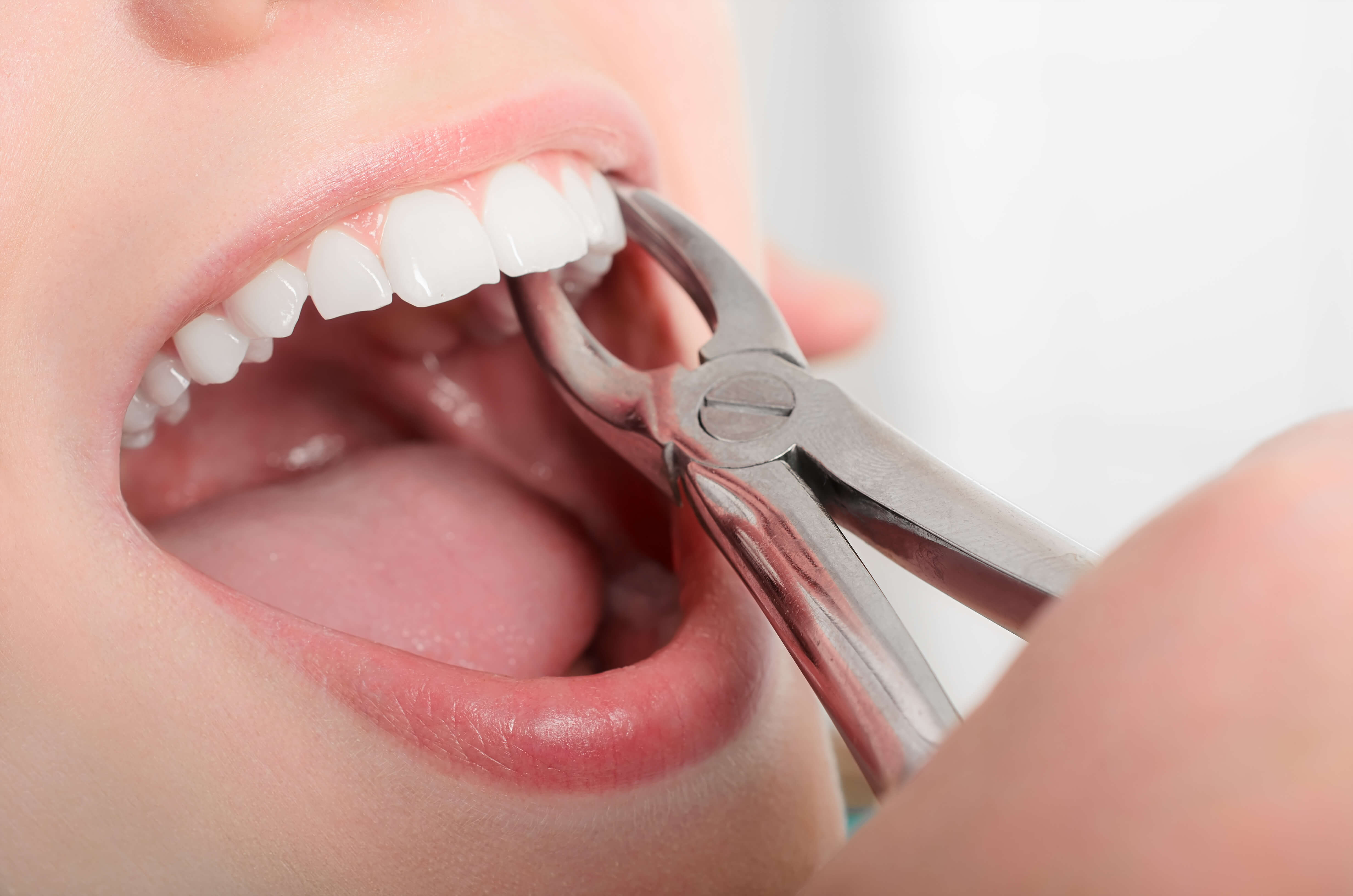 Tooth Extraction Healing Timeline Burke Dental Group
